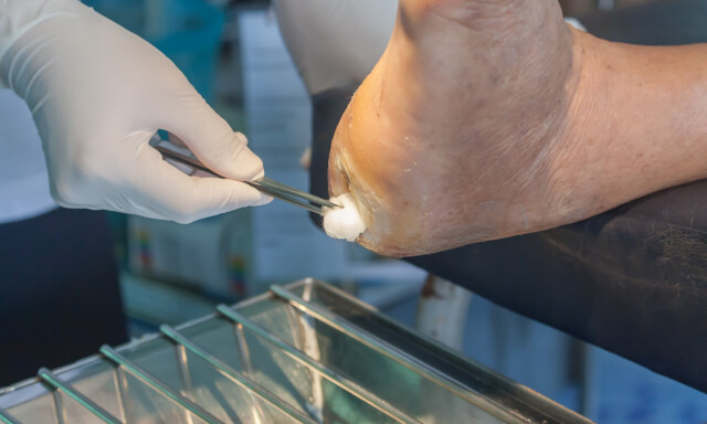 VIKTIG MED REGELMESSEIG SÅRSTELL OG INSPEKSJON: Pasienten bør ideelt sett følges opp ved tverrfaglig diabetisk fotteam. FOTO: Scanpix NTB / Shutterstock / kirov1976 VIKTIG MED REGELMESSEIG SÅRSTELL OG INSPEKSJON: Pasienten bør ideelt sett følges opp ved tverrfaglig diabetisk fotteam. FOTO: Scanpix NTB / Shutterstock / kirov1976